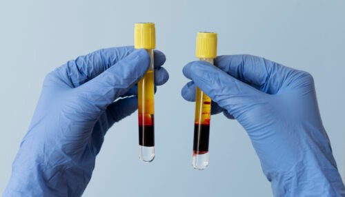 vials with prp - platelet rich plasma