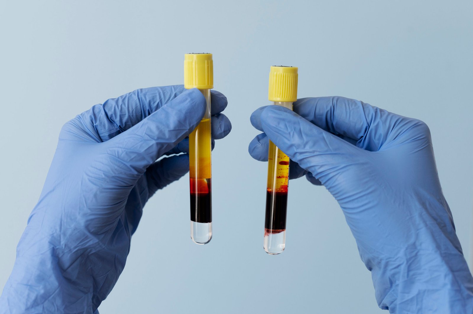 vials with prp - platelet rich plasma